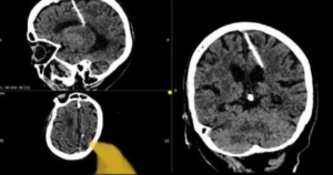 أطباء روس يعثرون على إبرة في دماغ امرأة منذ 80 عاماً